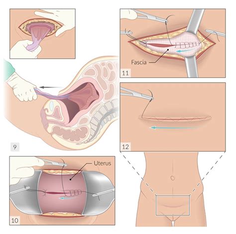 Cesarean Section Technique With Diagram