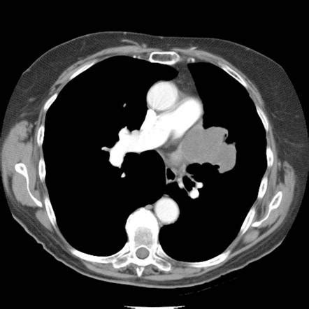 Pulmonary angiosarcoma | Image | Radiopaedia.org