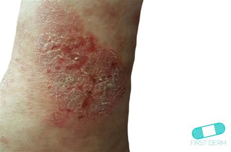 Neurodermatitis Online Dermatology