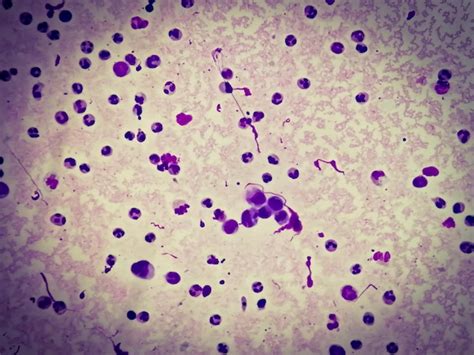 Premium Photo Synovial Fluid Cytology Showing Plenty WBC To Diagnose