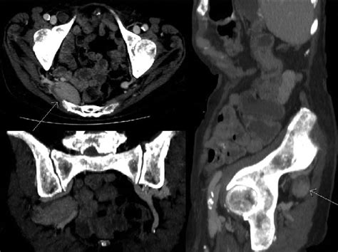 Multidetector Row Computed Tomography Axial Coronal And Sagittal