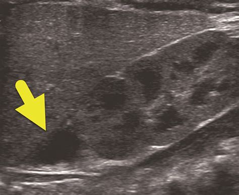 Neonatal Adrenal Hemorrhage Applied Radiology