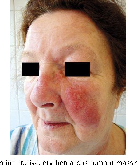 Figure 3 From A Case Of Diffuse Large B Cell Lymphoma Misdiagnosed As An Erysipelas Of The Face