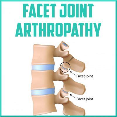 Facet Joint Arthropathy - Sports Medicine Review