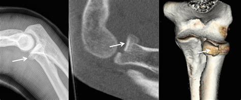 Fracture du coude Clinique Ostéo Articulaire des Cèdres Grenoble