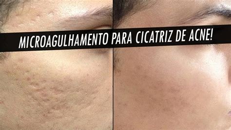 Como Remover De Vez Cicatriz De Acne Do Rosto Microagulhamento