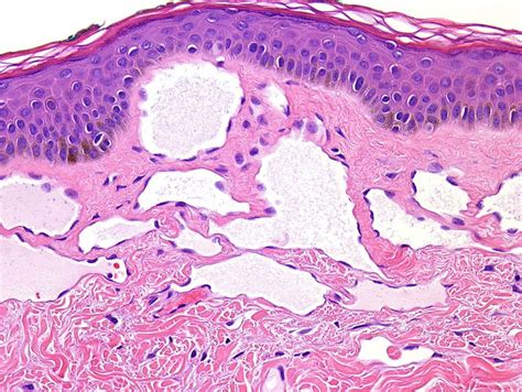 Cutaneous Angiosarcoma A Current Update Journal Of Clinical Pathology