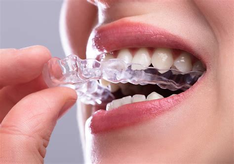 Clear Aligners Ventura Ca Invisalign® Suresmile® Reveal®