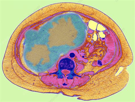 Liver cancer, CT scan - Stock Image - M134/0517 - Science Photo Library