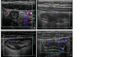 Color Doppler Ultrasonography And Diffusion Weighted Magnetic Resonance