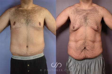 Tummy Tuck Before And After Men