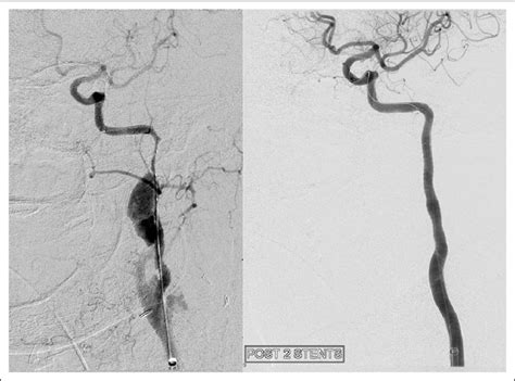 Angiogram Before And After Placement Of Stents Demonstrating