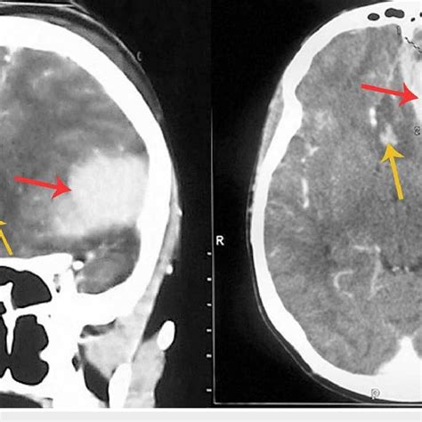 Patients Head Ct Scan Showing Left Frontal Epidural Bleed Red Arrow