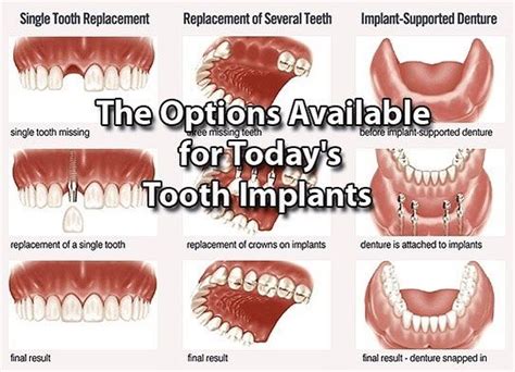 There Are Many Different Options For Replacing Missing Teeth From