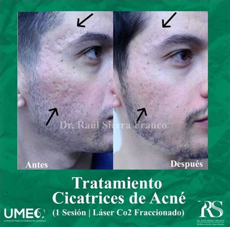 Láser CO2 Fraccionado Antes y después Multiestetica mx Multiestetica mx