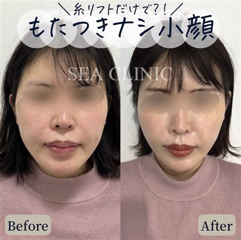 糸リフトだけでこの効果！！ Sea Clinic −シークリニック 銀座― 理想を叶える小顔治療