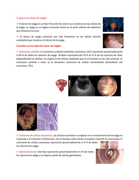 Gonzales 3 ALGO QUE PODRÁ AYUDARTE 1 Qué es el cáncer de vejiga