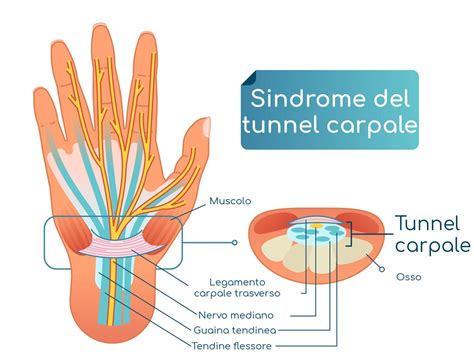 Sindrome Del Tunnel Carpale Sintomi Cause Intervento