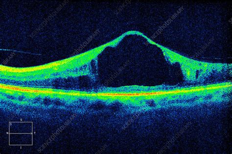 Diabetic macular oedema, OCT scan - Stock Image - C057/0660 - Science ...