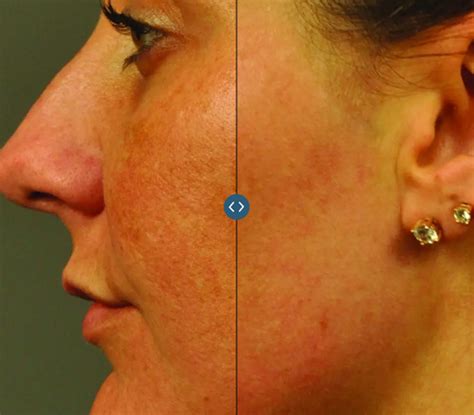 Clear Brilliant Laser London 1 Rated Clinic In Uk