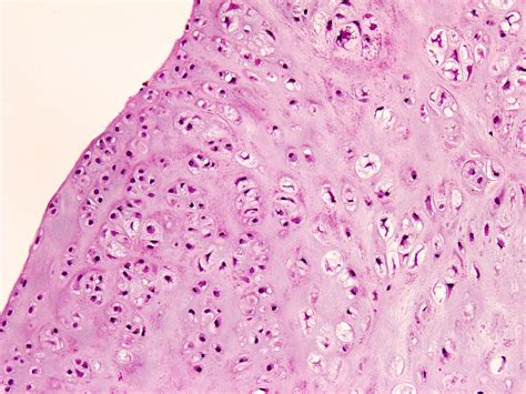 Pathology Outlines Synovial And Tenosynovial Chondromatosis