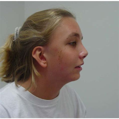 Adolescent With Turner Syndrome Note The Phenotypic Features