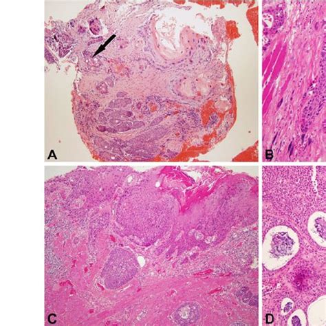 Histologic Features Of Adenosquamous Carcinoma A Biopsy Specimen