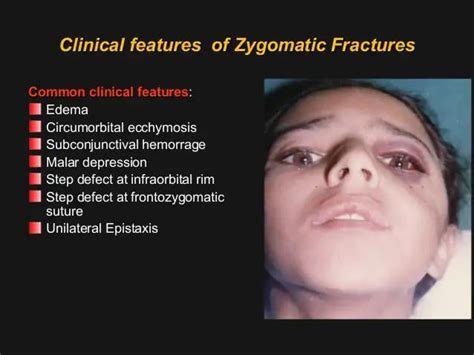 ZYGOMATIC ARCH FRACTURE : r/INBDE