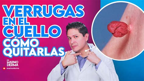 Descubre Qu Es Bueno Para Quitar Las Verrugas Del Cuello Remedios