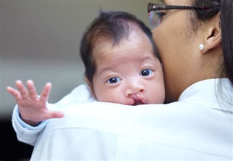 What Parents Need To Know About Cleft Lip And Palate Pediatrics