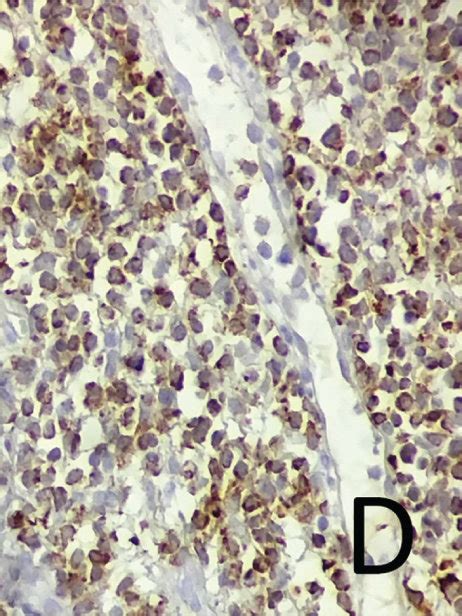 Histopathological Features In A The Histologic Section From The