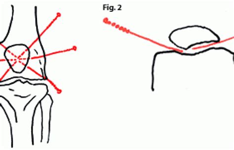 Direct Electric Acupuncture For Patella Chondromalacia A Preliminary