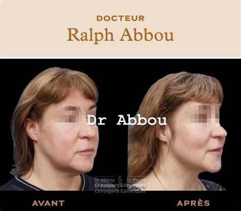 Mini Lifting Visage à Paris Dr Ralph Abbou