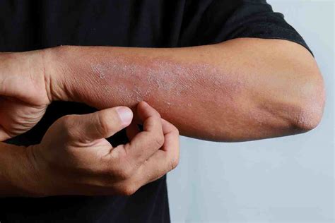 What Are The Symptoms Of Eczema How To Prevent And Relieve Eczema