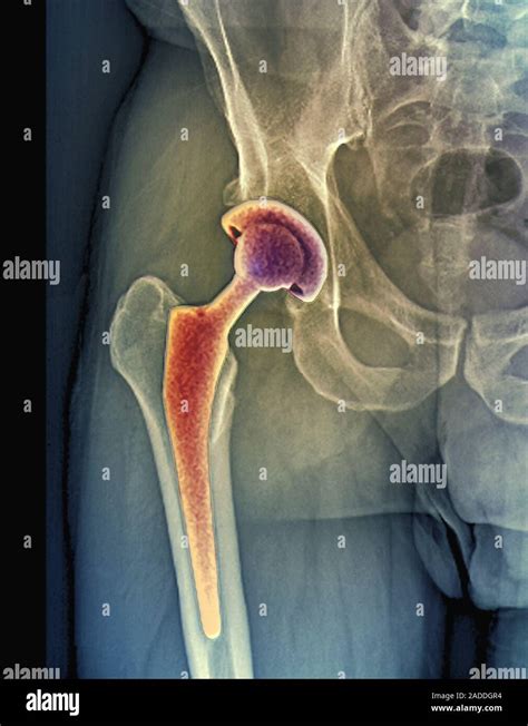 Total Hip Replacement Coloured Frontal X Ray Of The Right Hip Of A 54