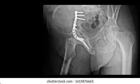 Film X Ray Hip Radiograph Show Stock Photo 1615876663 | Shutterstock