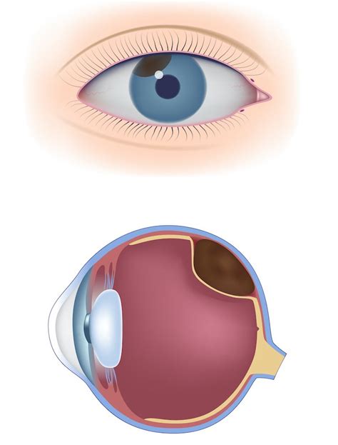 Radiochirurgia Stereotassica Per Melanoma Uveale