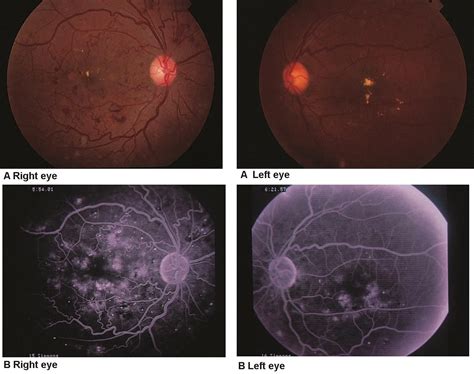 Nonproliferative Diabetic Retinopathy American Academy Of Ophthalmology