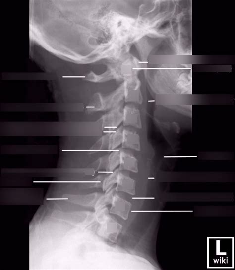 LATERAL C-SPINE/GRANDY (X-RAY ANATOMY) Diagram | Quizlet