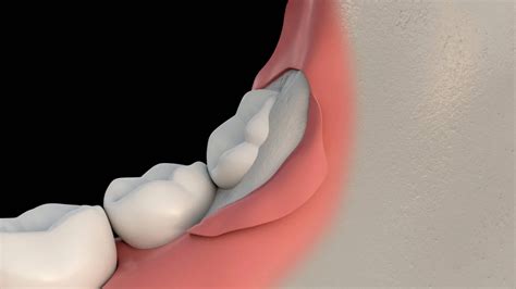 Wisdom Teeth Removal Surgery A Complete Guide Wisdom Teeth Factory