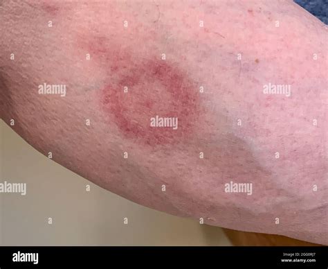 Bullseye Rash On Lower Leg Sign Of Lyme Disease Nine Days After Bite Color Fading After Five