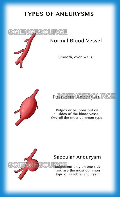 Types Of Aneurysms Stock Image Science Source Images