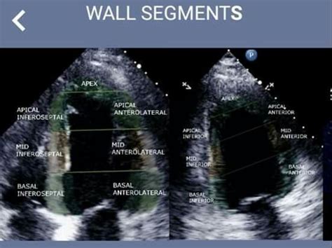 Pin by Natalie B on Heart love in 2023 | Cardiac sonography, Diagnostic ...