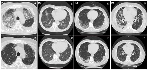 Ijerph Free Full Text Pneumocystis Jirovecii Pneumonia In Non Hiv Patients Recovering From