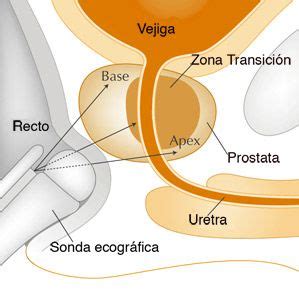 Prostate cancer Centro Gil Vernet de Urología