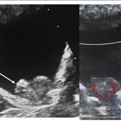 Transverse Grayscale Ultrasound A And Color Doppler B Image Through