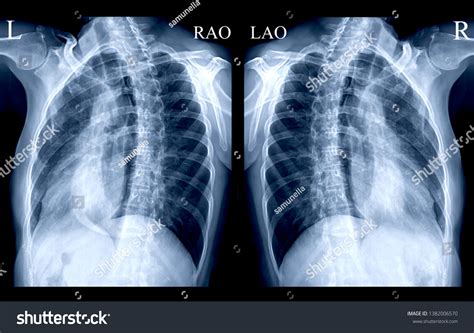 Chest Xray Xray Image Human Both Stock Photo 1382006570 Shutterstock