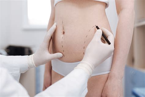 Abdominoplastie pour un ventre plat Chirurgie esthétique du corps