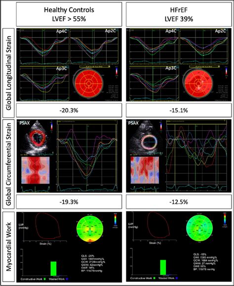 Measurement Of LV Strain And Myocardial Work A2C Apical Two Chamber