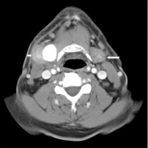 Figure From Giant Sialolith Of The Submandibular Salivary Gland